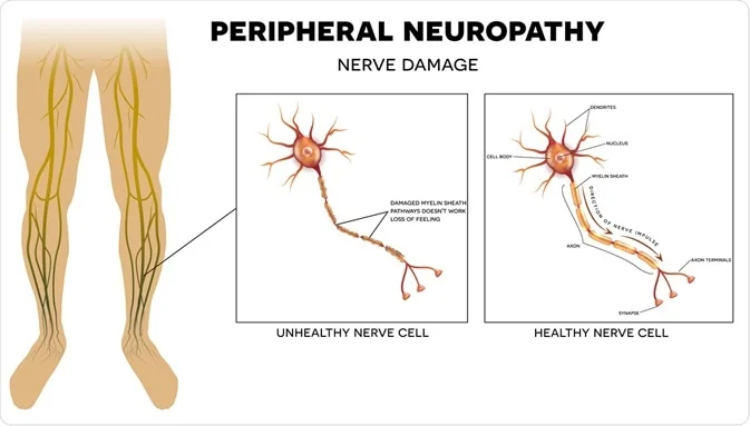 Damage done to the nervous system because of peripheral neuropathy.