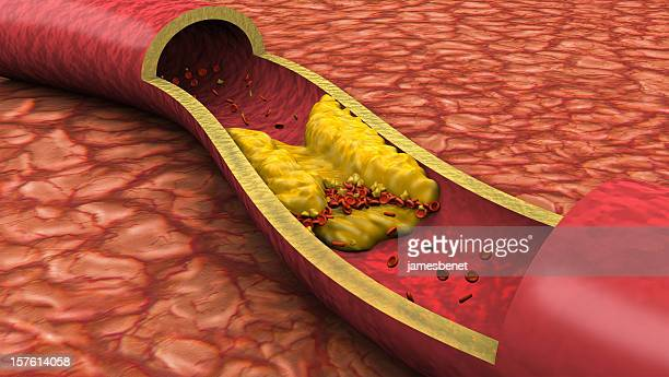 Cholesterol in blood.