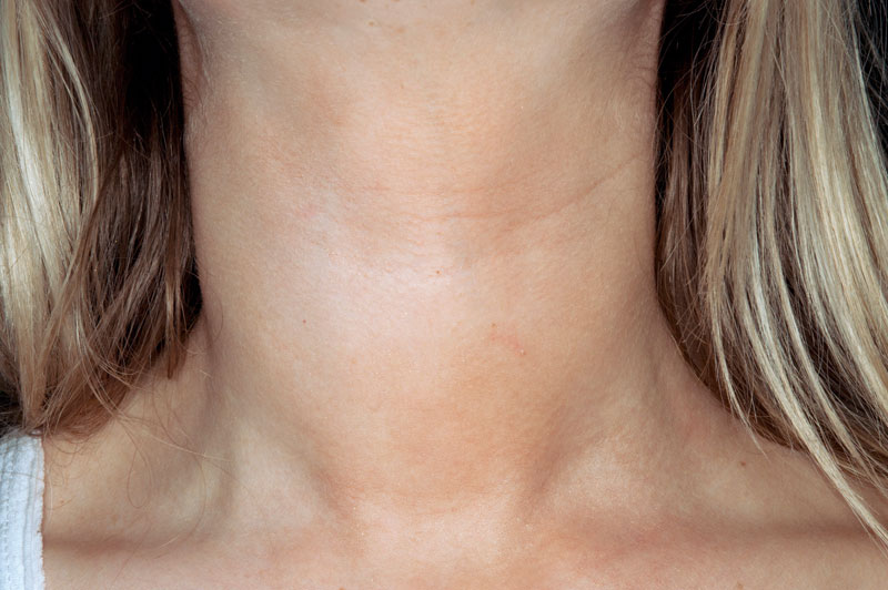 A lady suffering from hypothyroidism.